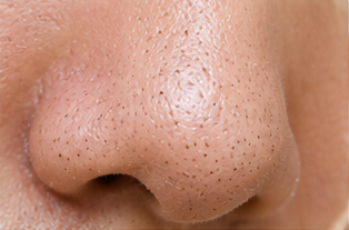 Blackheads & Pores